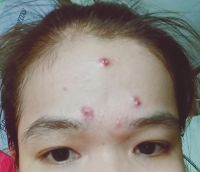 Gợi ý sản phẩm cứu giúp làn da mụn trong nhiều năm?