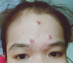 Gợi ý sản phẩm cứu giúp làn da mụn trong nhiều năm?