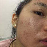 Mỗi lỗ chân lông là một cái mụn là sao?