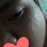 Phương pháp điều trị hiệu quả mụn và sẹo li ti? Phương pháp điều trị hiệu quả mụn và sẹo li ti?