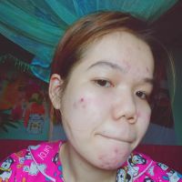 Gợi ý sản phẩm cứu giúp làn da mụn trong nhiều năm?