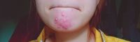Gợi ý sản phẩm cứu giúp làn da mụn trong nhiều năm?