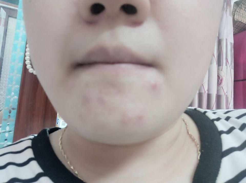 Stress kinh khủng về mụn ở cằm, toàn mụn to đùng, rắn, đau.