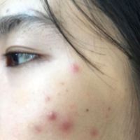 Ăn sầu riêng bị nổi mụn phải làm sao? Ăn sầu riêng bị nổi mụn phải làm sao?