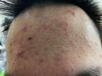 Tìm phương án trị mụn?