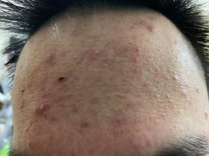 Tìm phương án trị mụn?