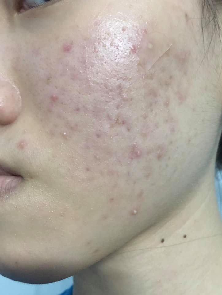 Da mụn có dùng được các sản phẩm trên không?