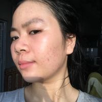 Sản phẩm trị sẹo nào tốt cho da mỏng?