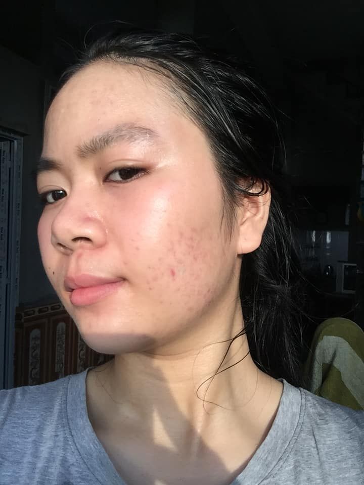 Sản phẩm trị sẹo nào tốt cho da mỏng? Sản phẩm trị sẹo nào tốt cho da mỏng?