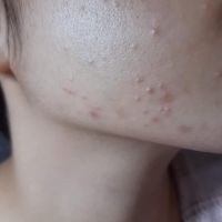 Mụn ẩn hay mụn nội tiết? Hướng điều trị thế nào? Mụn ẩn hay mụn nội tiết? Hướng điều trị thế nào?