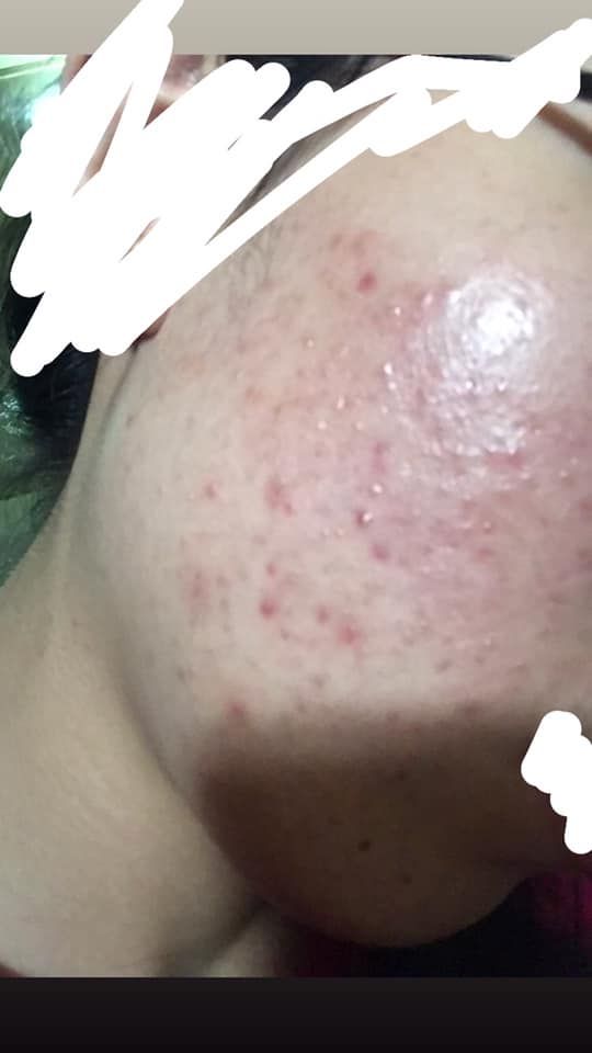 Phương pháp chăm sóc cho da mặt bị mụn nặng