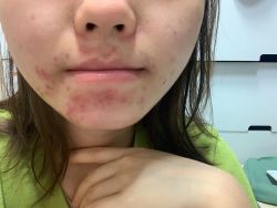 Bị mụn quanh miệng trị không khỏi