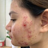 Trị mụn viêm mủ mãi không khỏi phải làm gì? Trị mụn viêm mủ mãi không khỏi phải làm gì?