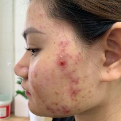 Trị mụn viêm mủ mãi không khỏi phải làm gì?