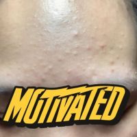 Nên ngưng hết các sản phẩm skincare không?