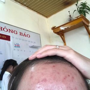 Mụn nội tiết ở cằm và trán đã 10 năm phải làm sao?