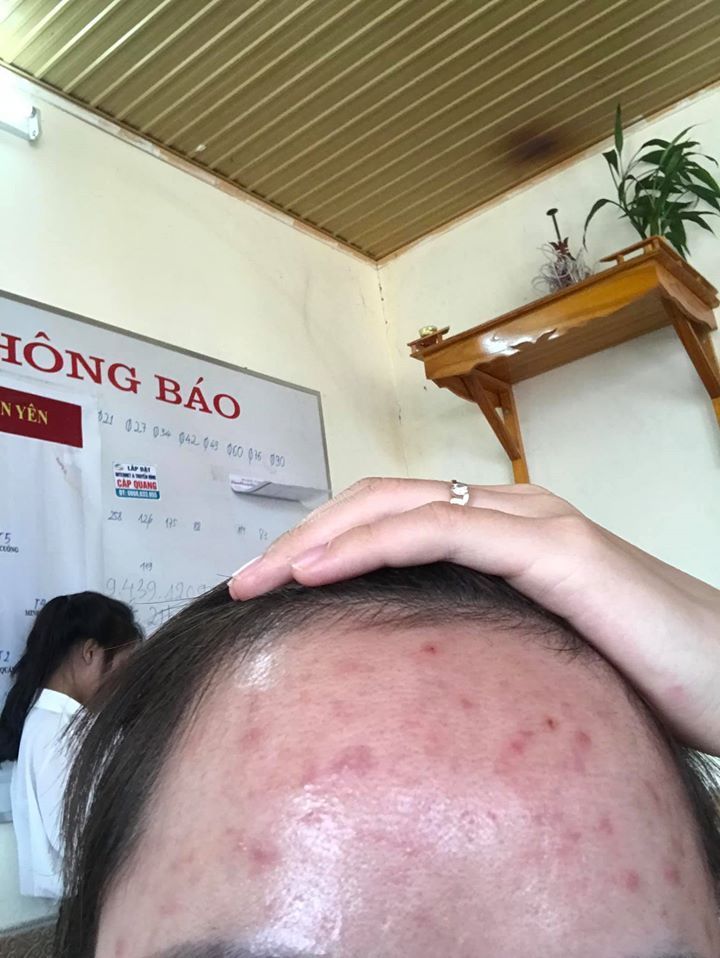 Mụn nội tiết ở cằm và trán đã 10 năm phải làm sao? Mụn nội tiết ở cằm và trán đã 10 năm phải làm sao?