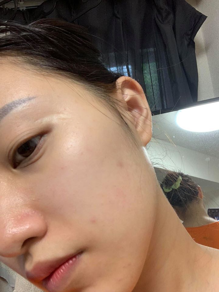 Nổi mụn lấm tấm ở trán và cằm phải làm sao?