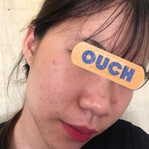 Dùng sản phẩm trị mụn nào hiệu quả?