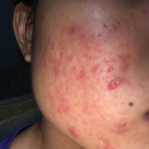 Tìm phương pháp và sản phẩm trị mụn thích hợp?