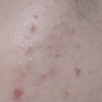 Chăm sóc da bị mụn ẩn