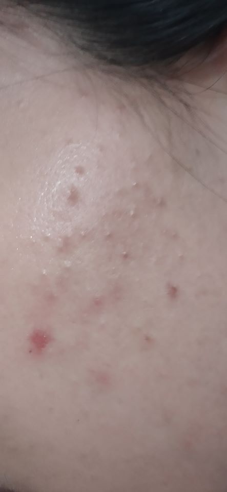 Chăm sóc da bị mụn ẩn Chăm sóc da bị mụn ẩn