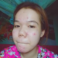 Gợi ý sản phẩm cứu giúp làn da mụn trong nhiều năm?