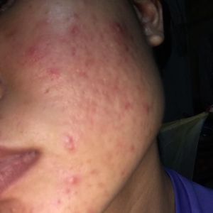 Tìm phương pháp và sản phẩm trị mụn thích hợp?