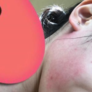 Có phải kích ứng mĩ phẩm không?