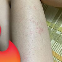 Cách khắc phục tình trạng mụn và ngứa sau khi đi triệt lông?