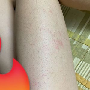 Cách khắc phục tình trạng mụn và ngứa sau khi đi triệt lông?