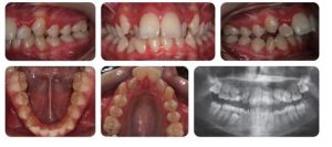 Phân tích case: Niềng răng thành công cho bệnh nhân bị hô, cắn chìa đang độ tuổi phát triển