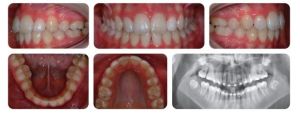 Phân tích case: Niềng răng thành công cho bệnh nhân bị hô, cắn chìa đang độ tuổi phát triển