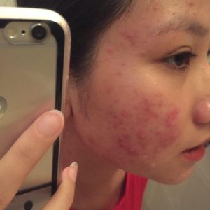 Khắc phục tình trạng mụn bọc như thế nào?