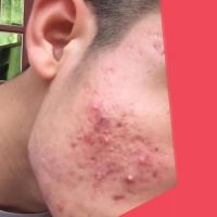 Cách chữa trị mặt mụn và da bị viêm nặng?