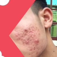 Cách chữa trị mặt mụn và da bị viêm nặng?