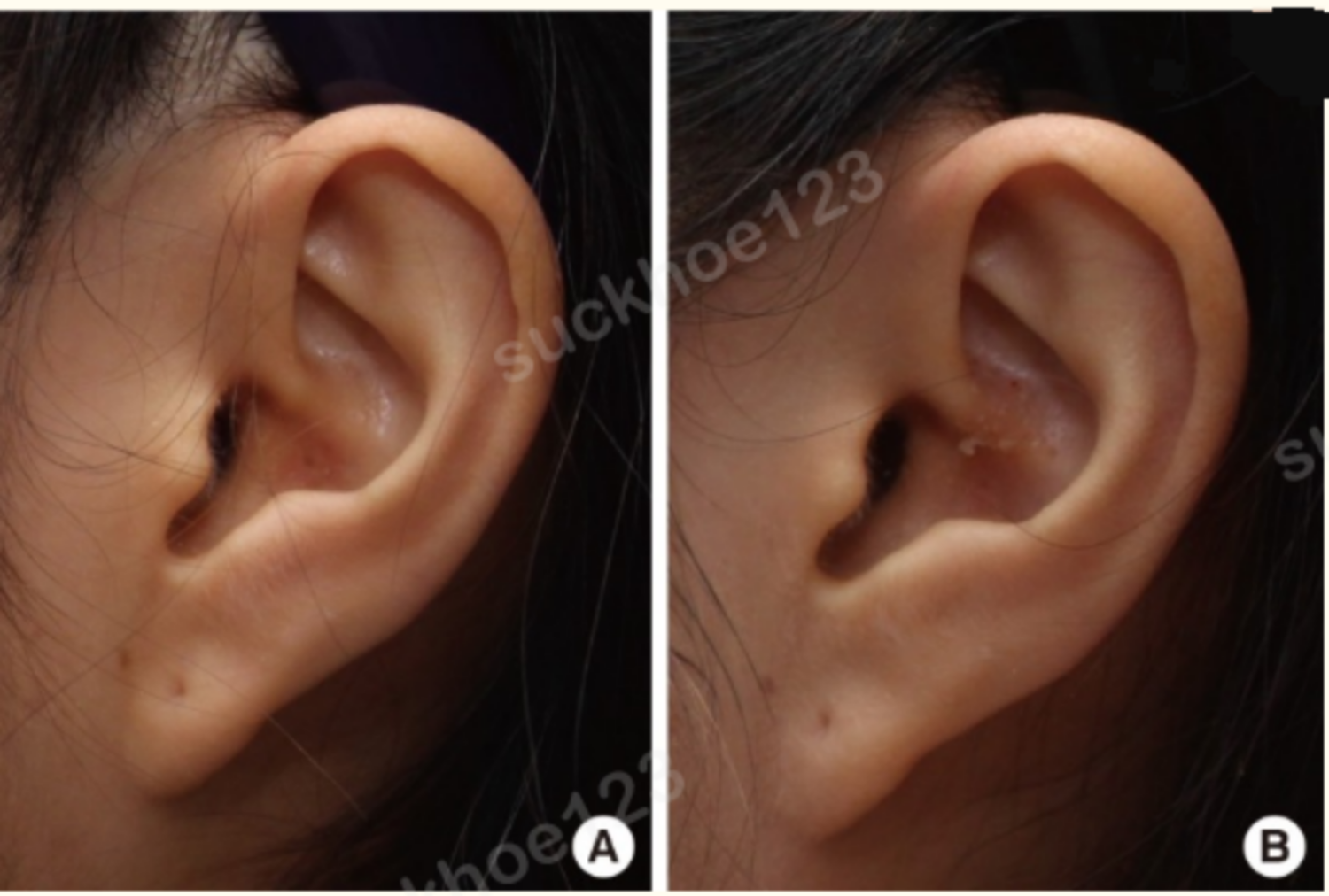 bệnh nhân trước và sau khi lấy sụn tai