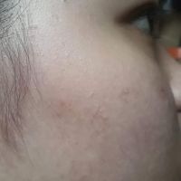 Dùng sẩn phẩm trị mụn và thâm mụn đã đúng chưa? Dùng sẩn phẩm trị mụn và thâm mụn đã đúng chưa?