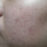 Dùng sẩn phẩm trị mụn và thâm mụn đã đúng chưa? Dùng sẩn phẩm trị mụn và thâm mụn đã đúng chưa?