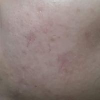 Dùng sẩn phẩm trị mụn và thâm mụn đã đúng chưa? Dùng sẩn phẩm trị mụn và thâm mụn đã đúng chưa?