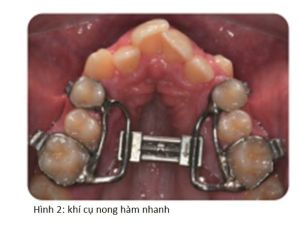 Phân tích case: Niềng răng có dùng nong nhanh hàm trên cho bệnh nhân sai khớp cắn loại I