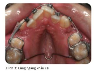 Phân tích case: Niềng răng có dùng nong nhanh hàm trên cho bệnh nhân sai khớp cắn loại I