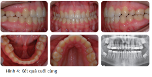 Phân tích case: Niềng răng có dùng nong nhanh hàm trên cho bệnh nhân sai khớp cắn loại I