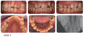 Phân tích caser: Niềng răng cho bệnh nhân 15 tuổi thay răng chậm, hàm chen chúc, có nhiểu răng vĩnh viễn mọc ngầm
