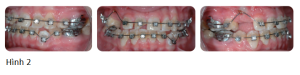 Phân tích caser: Niềng răng cho bệnh nhân 15 tuổi thay răng chậm, hàm chen chúc, có nhiểu răng vĩnh viễn mọc ngầm
