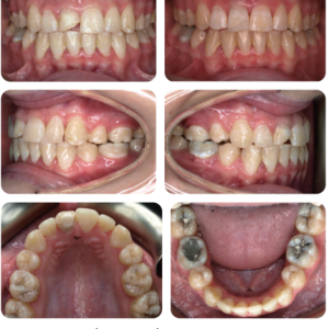 Phân tích caser: Niềng răng cho bệnh nhân 15 tuổi thay răng chậm, hàm chen chúc, có nhiểu răng vĩnh viễn mọc ngầm