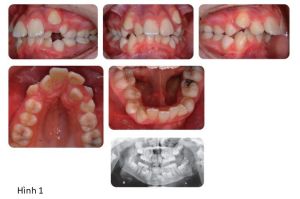 Phân tích case: Ca niềng răng thành công cho bệnh nhân bị hô, răng chen chúc, phức tạp