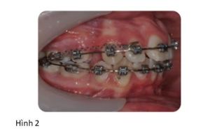 Phân tích case: Ca niềng răng thành công cho bệnh nhân bị hô, răng chen chúc, phức tạp