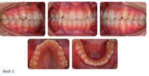 Phân tích case: Niềng răng thành công cho bệnh nhân bị hô 2 hàm, có nhổ 4 răng hàm nhỏ