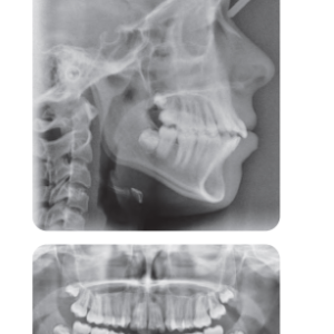 Phân tích case: Niềng răng thành công cho bệnh nhân bị hô 2 hàm, có nhổ 4 răng hàm nhỏ